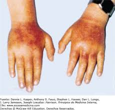 Resultado de imagen para Protoporfiria eritropoyética y protoporfiria ligada al cromosoma X